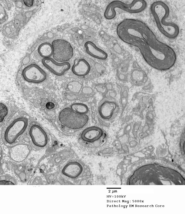 20D6 Suprascapular nerve (Case 20) EM Neuroma_043A - Copy