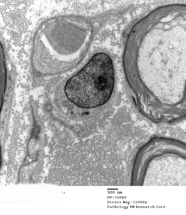 20E2 Suprascapular nerve (Case 20) EM 021A - Copy