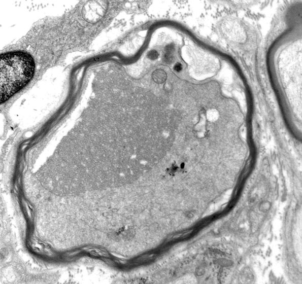 20E3 Suprascapular nerve (Case 20) EM 024A - Copy