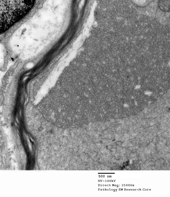 20E4 Suprascapular nerve (Case 20) EM 025A - Copy