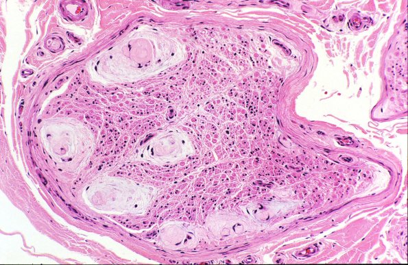 21A Renaut bodies (Case 21) H&E 1