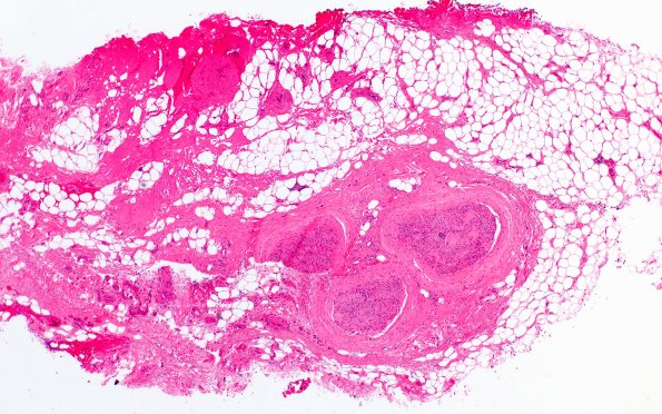 22A1 Median nerve compression (Case 22) H&E 4X