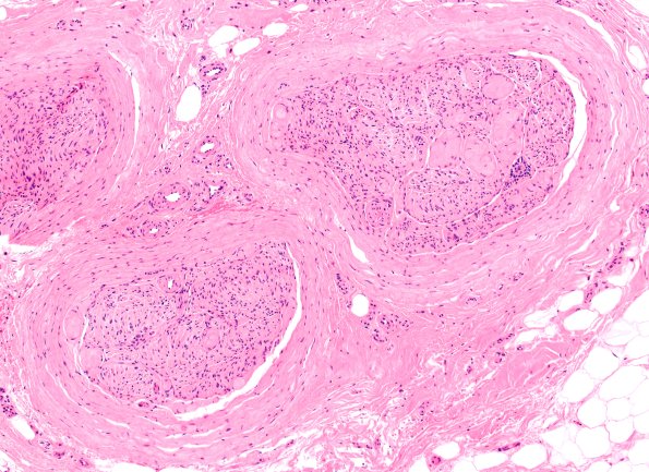 22A2 Median nerve compression (Case 22) H&E 10X 3