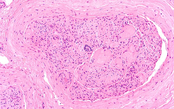 22A3 Median nerve compression (Case 22) H&E 20X 1A