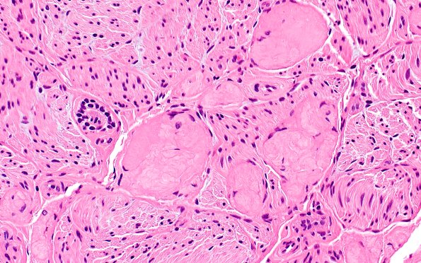22A4 Median nerve compression (Case 22) H&E 40XA