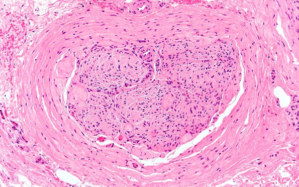 22A5 Median nerve compression (Case 22) H&E 20X 2A