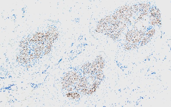 22B1 Median nerve compression (Case 22) NF 10X 1