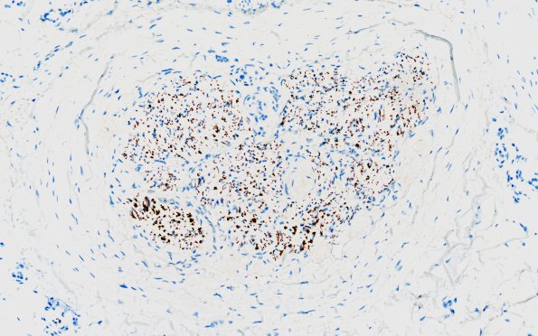 22B2 Median nerve compression (Case 22) NF 20X 1