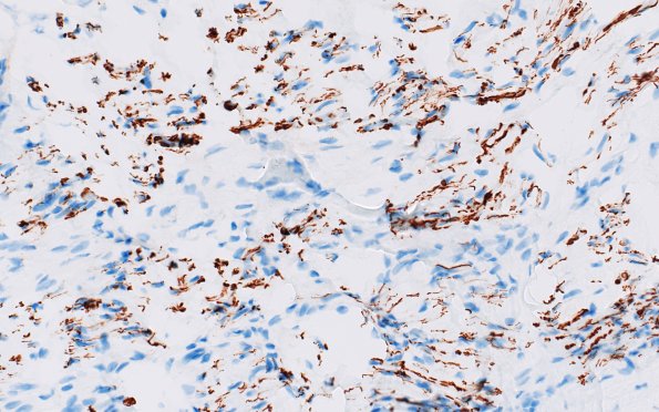 22B3 Median nerve compression (Case 22) NF 40X 2