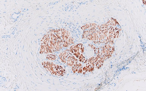 22C1 Median nerve compression (Case 22) S100 20X 1