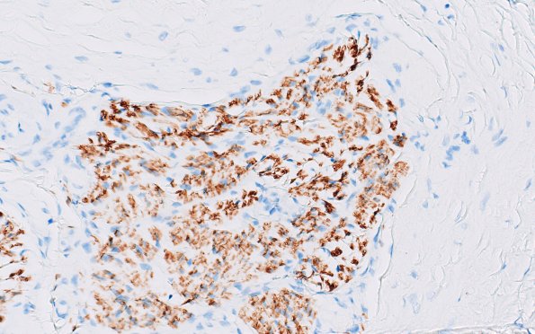 22C2 Median nerve compression (Case 22) S100 40X 2