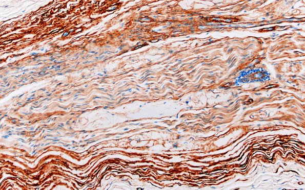 22D2 Median nerve compression (Case 22) Coll IV 20X 2