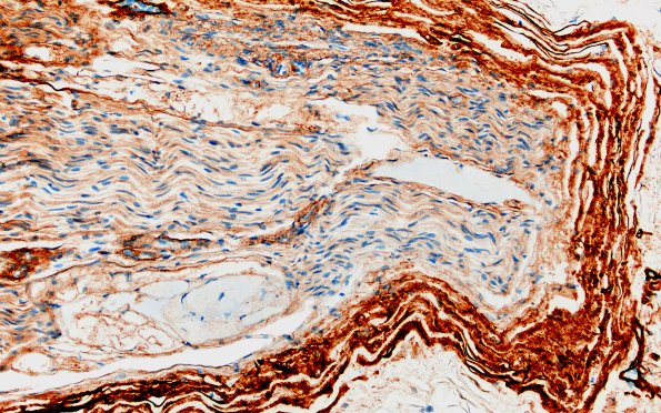 22D3 Median nerve compression (Case 22) Coll IV 20X 3