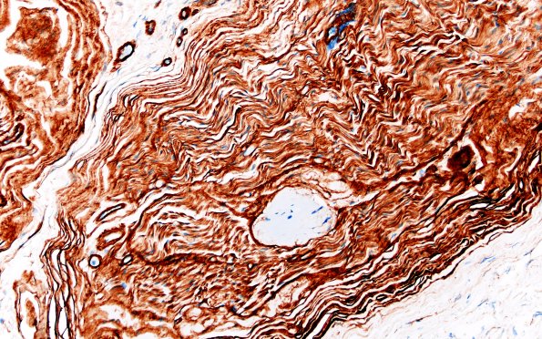 22D4 Median nerve compression (Case 22) Coll IV 20X