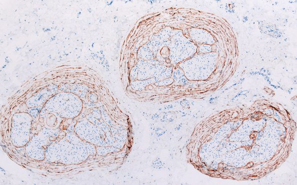 22E2 Median nerve compression (Case 22) EMA 10X 5