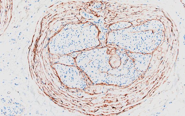22E3 Median nerve compression (Case 22) EMA 20X 5B