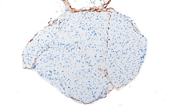 22E5 AIN, normal (Case 22A) EMA 20X