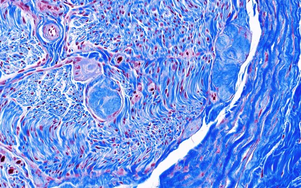 22F2 Median nerve compression (Case 22) Trichrome 20X 3