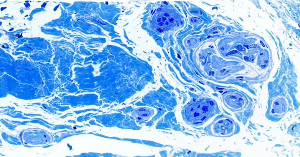 22G1 Median nerve compression (Case 22) Plastic 40X 1