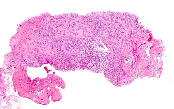 23A1 Neuroma (Case 23) H&E 4X A