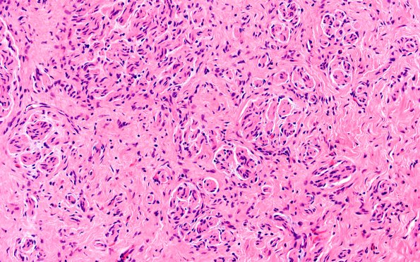 23A2 Neuroma (Case 23) H&E 20X