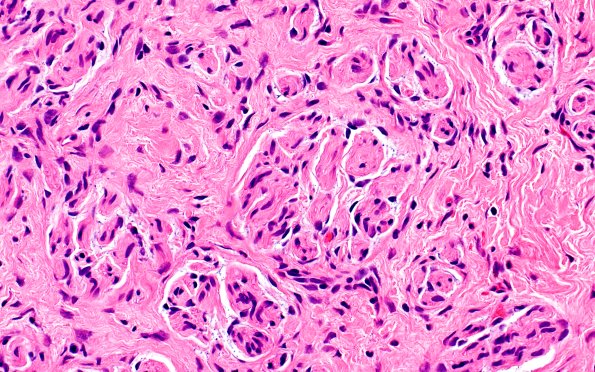 23A3 Neuroma (Case 23) H&E 40X