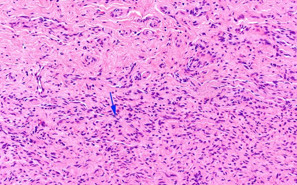 23A4 Neuroma (Case 23) H&E 20X 2 copy