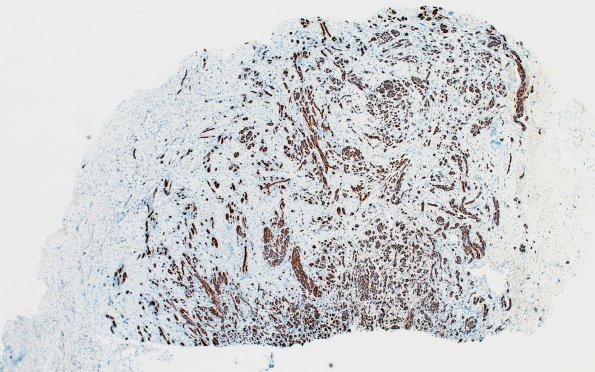 23B1 Neuroma (Case 23) NF 4X 5