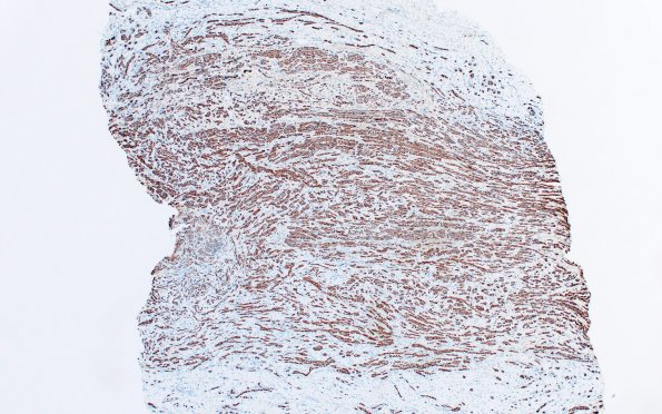 23B2 Neuroma (Case 23) NF 4X 4