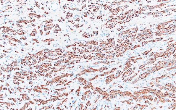 23B3 Neuroma (Case 23) NF 20X 1