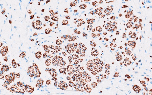 23B4 Neuroma (Case 23) NF 40X
