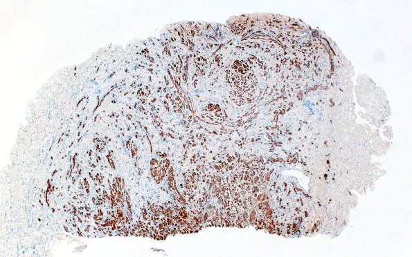 23D1 Neuroma (Case 23) S100 4X