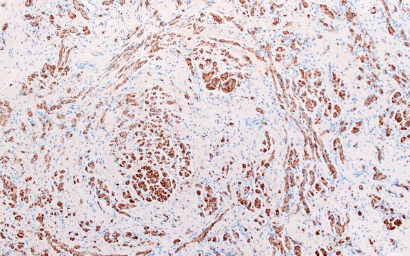 23D2 Neuroma (Case 23) S100 10X