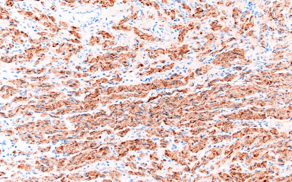 23D3 Neuroma (Case 23) S100 20X