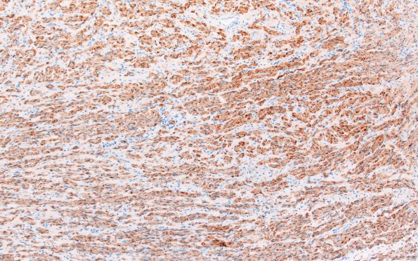 23D4 Neuroma (Case 23) S100 10X 2