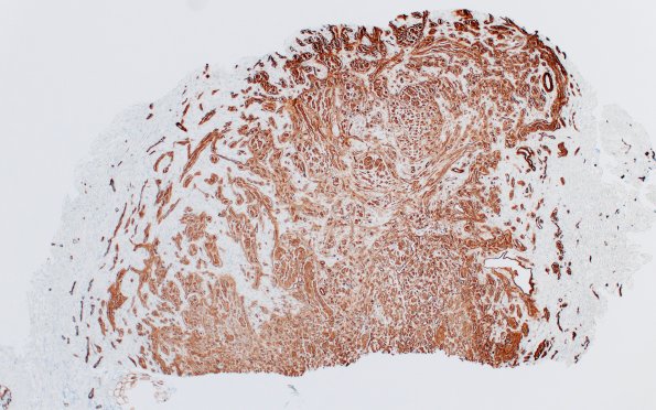 23E1 Neuroma (Case 23) CollIV 4X 2