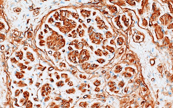 23E2 Neuroma (Case 23) Coll IV area A 40X 2