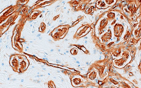 23E3 Neuroma (Case 23) CollIV 40X 1