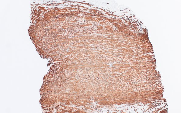 23E4 Neuroma (Case 23) CollIV 4X