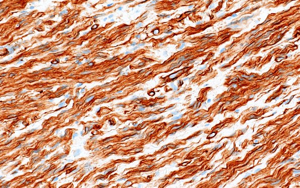 23E5 Neuroma (Case 23) CollIV 40X 2