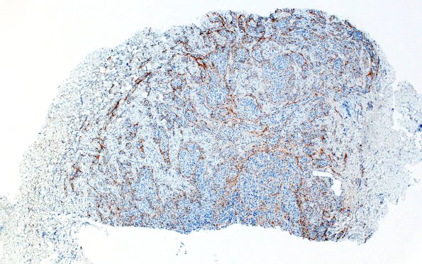 23F1 Neuroma (Case 23) EMA 4X