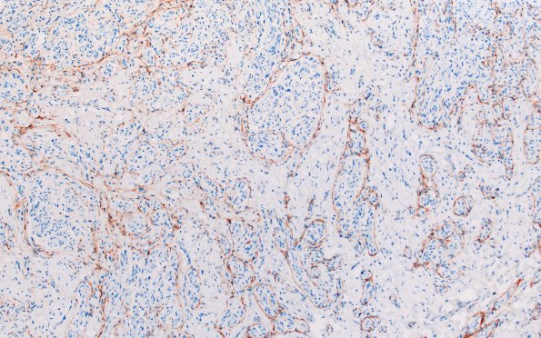 23F2 Neuroma (Case 23) EMA 10X