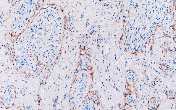23F3 Neuroma (Case 23) EMA 20X