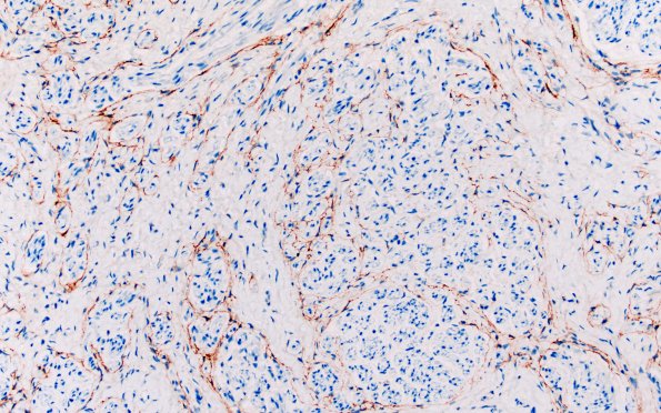 23F5 Neuroma (Case 23) EMA 20X area A 20X