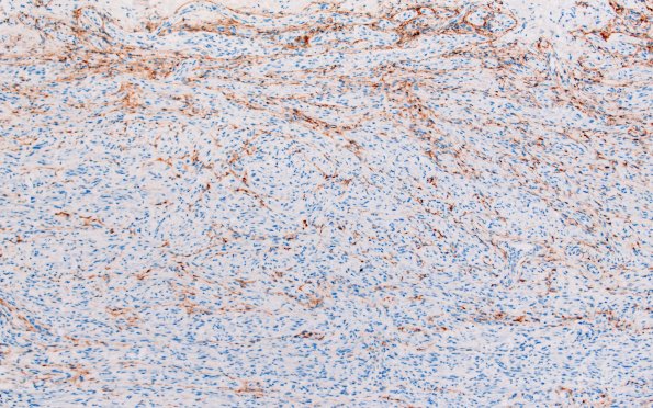 23F6 Neuroma (Case 23) EMA 10X 2