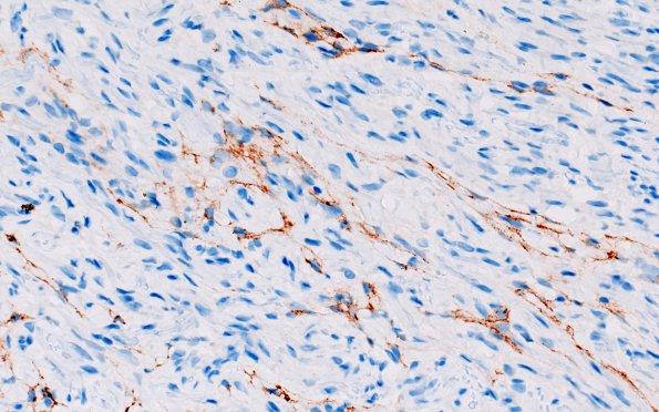 23F7 Neuroma (Case 23) EMA 40X