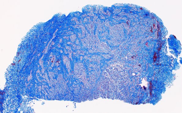 23G1 Neuroma (Case 23) Trichrome 4X