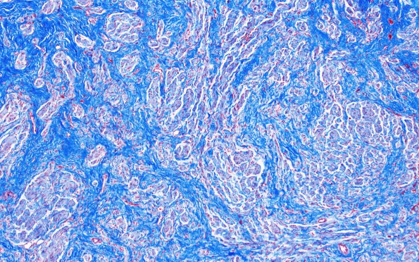 23G2 Neuroma (Case 23) Trichrome 10X