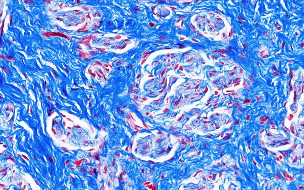 23G3 Neuroma (Case 23) Trichrome 40X