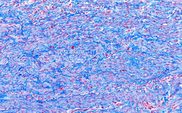 23G4 Neuroma (Case 23) Trichrome 20X